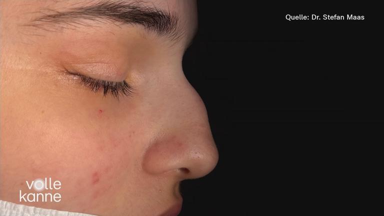 Frau mit verkrümmter Nase im Profil