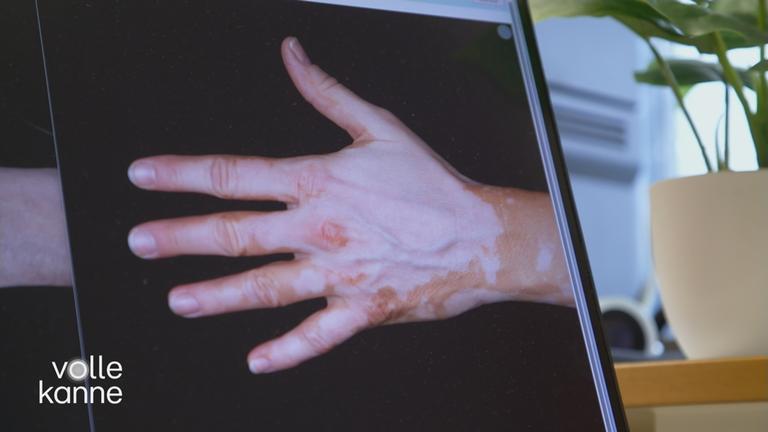 Neuer Wirkstoff bei Vitiligo