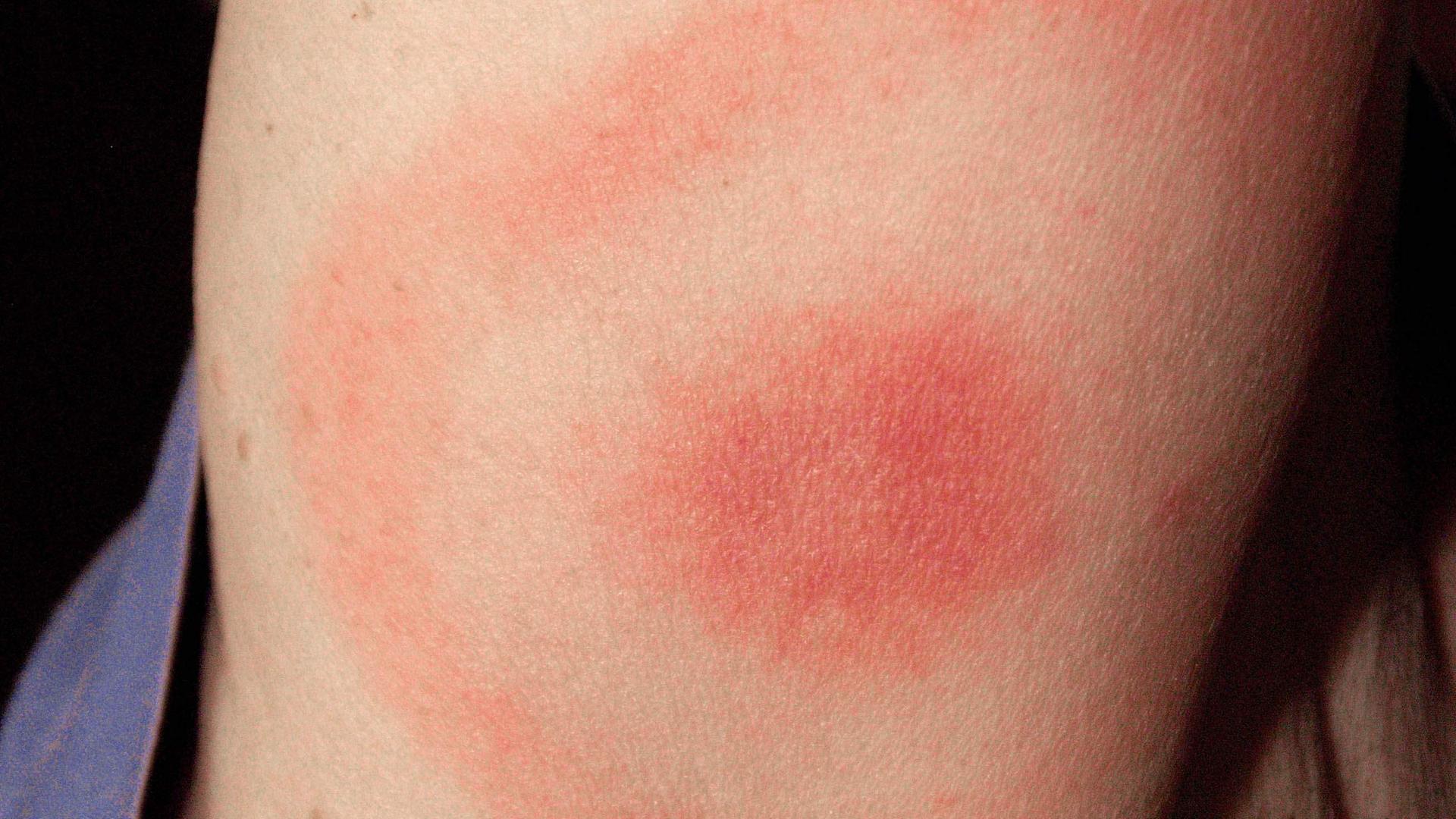 Wanderröte - Symptom einer Borreliose nach Zeckenbiss