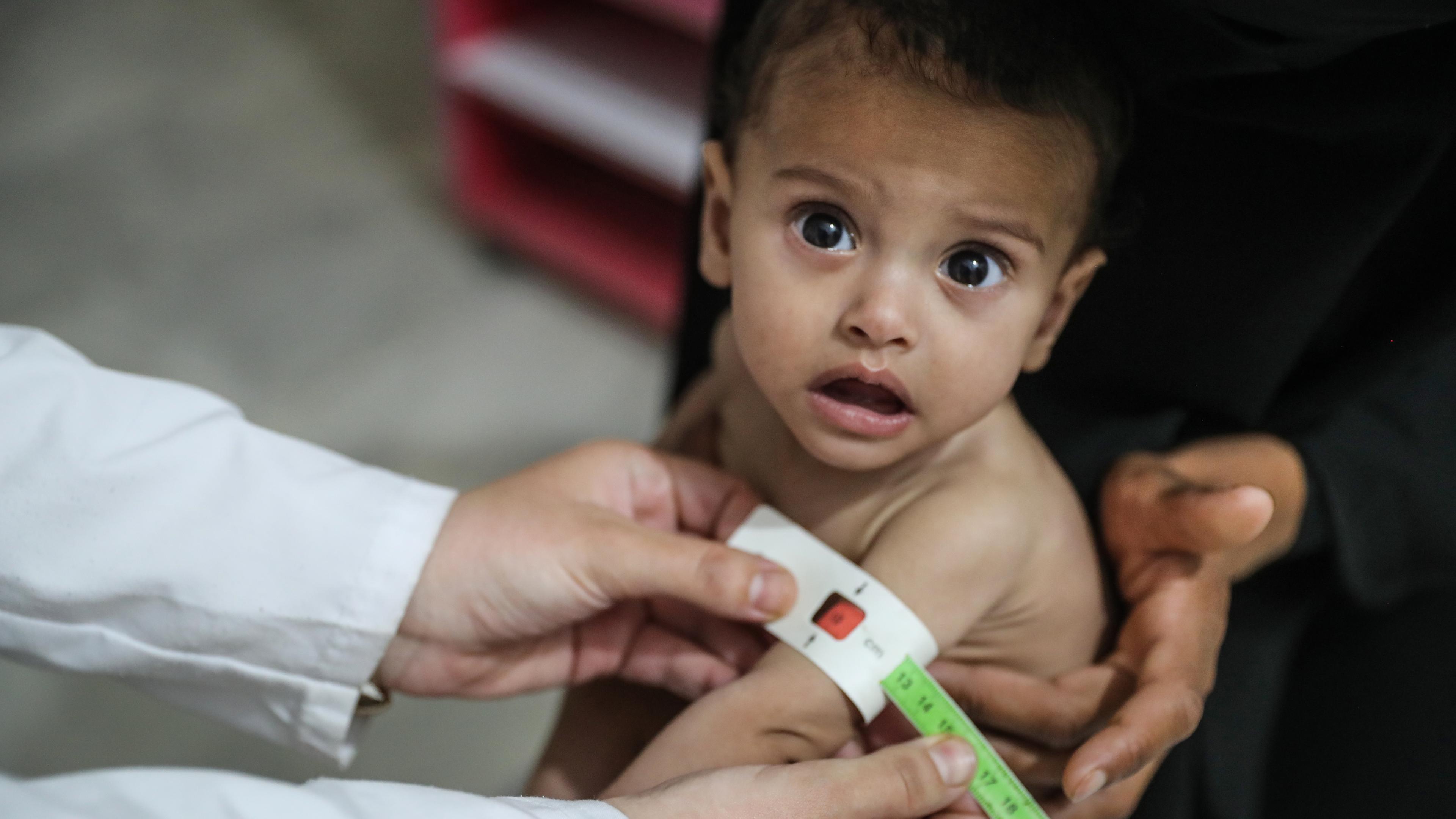Zu sehen ist ein Kind in Syrien, das wegen Unterernährng medzinisch behandelt werden muss.