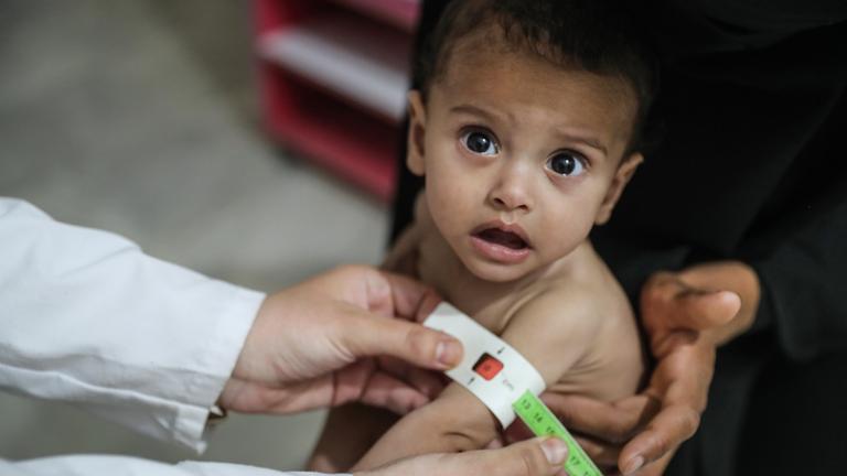 Zu sehen ist ein Kind in Syrien, das wegen Unterernährng medzinisch behandelt werden muss.