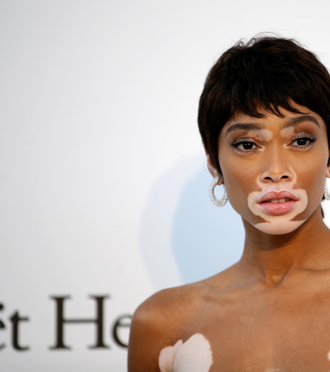 Winnie Harlow - Model mit weißen Flecken