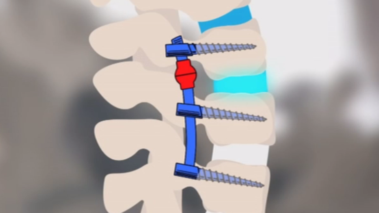 Wirbelsäulenstoßdämpfer Grafik
