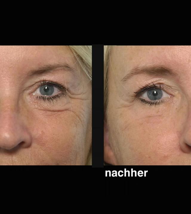Vorher-Nachher-Test mit Ampullen gegen Tränensäcke