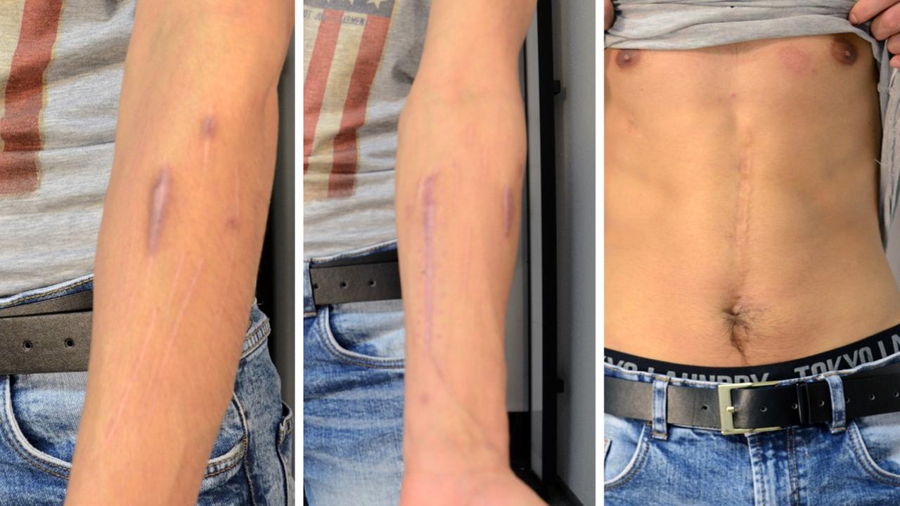Auffällige Narben, die Mohammad Suliman Niyazi an beiden Armen und am Bauch trägt.