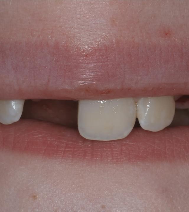 Foto von einem Gebiss, bei dem der Schneidezahn fehlt