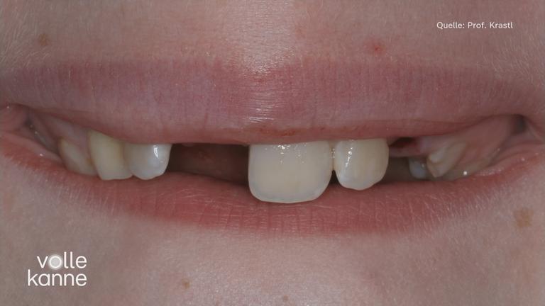 Foto von einem Gebiss, bei dem der Schneidezahn fehlt