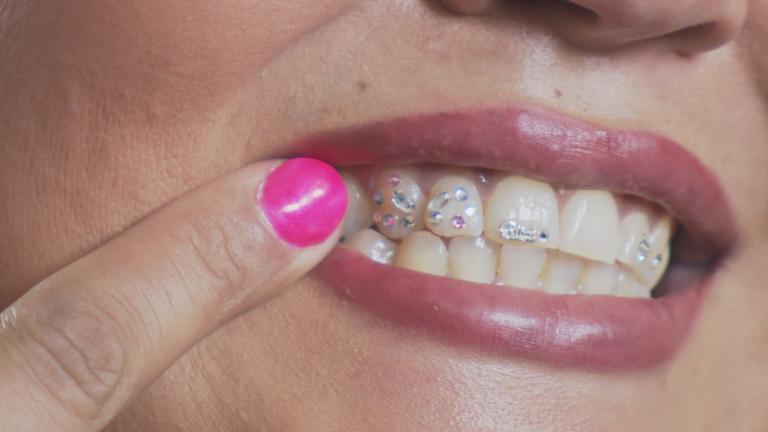 Zahnschmuck aus London