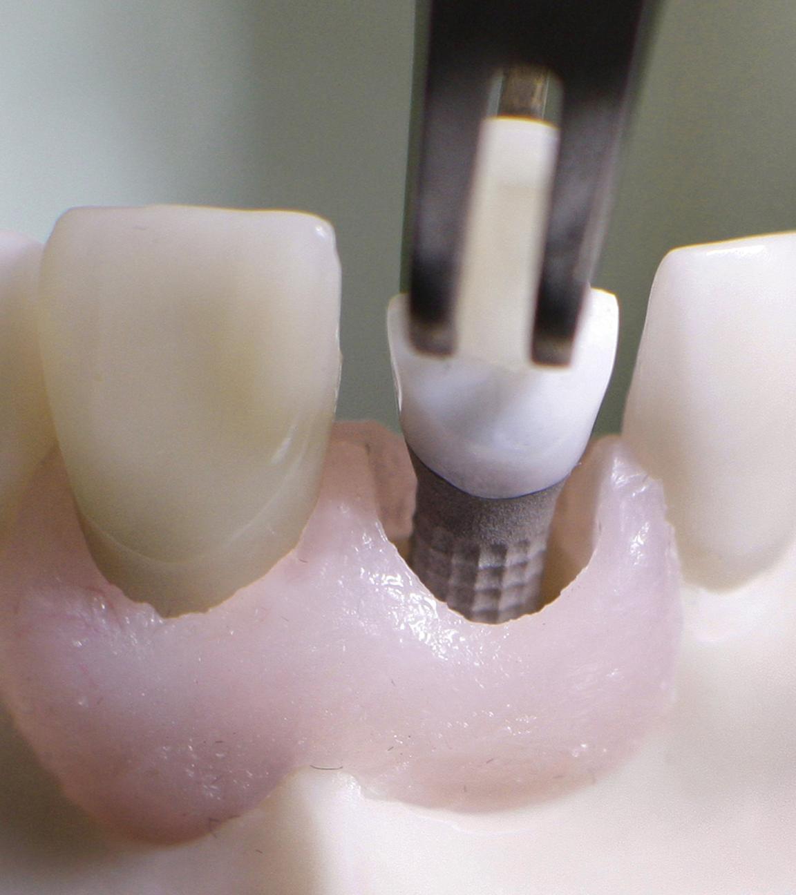 Zahnbehandlungen sind sehr teuer. Gerade wenn es um Zahnbrücken, Implantate oder Zahnersatz geht.