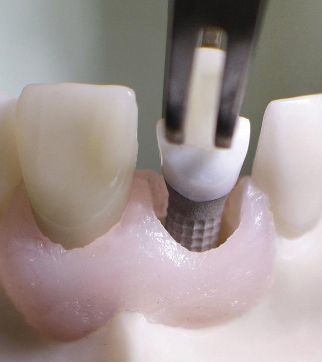 Zahnbehandlungen sind sehr teuer. Gerade wenn es um Zahnbrücken, Implantate oder Zahnersatz geht.