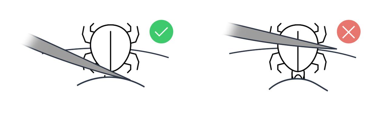 Die Grafik zeigt, wie man Zecken entfernen sollte - und wie nicht