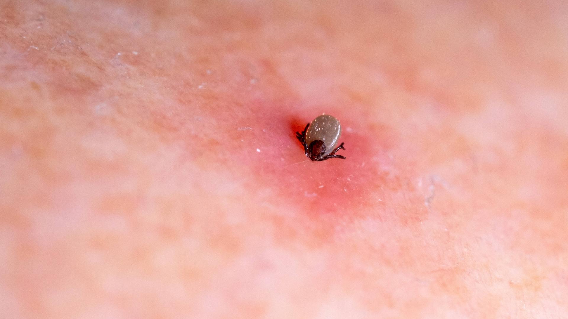 Eine Zecke in Nahaufnahme auf der Haut