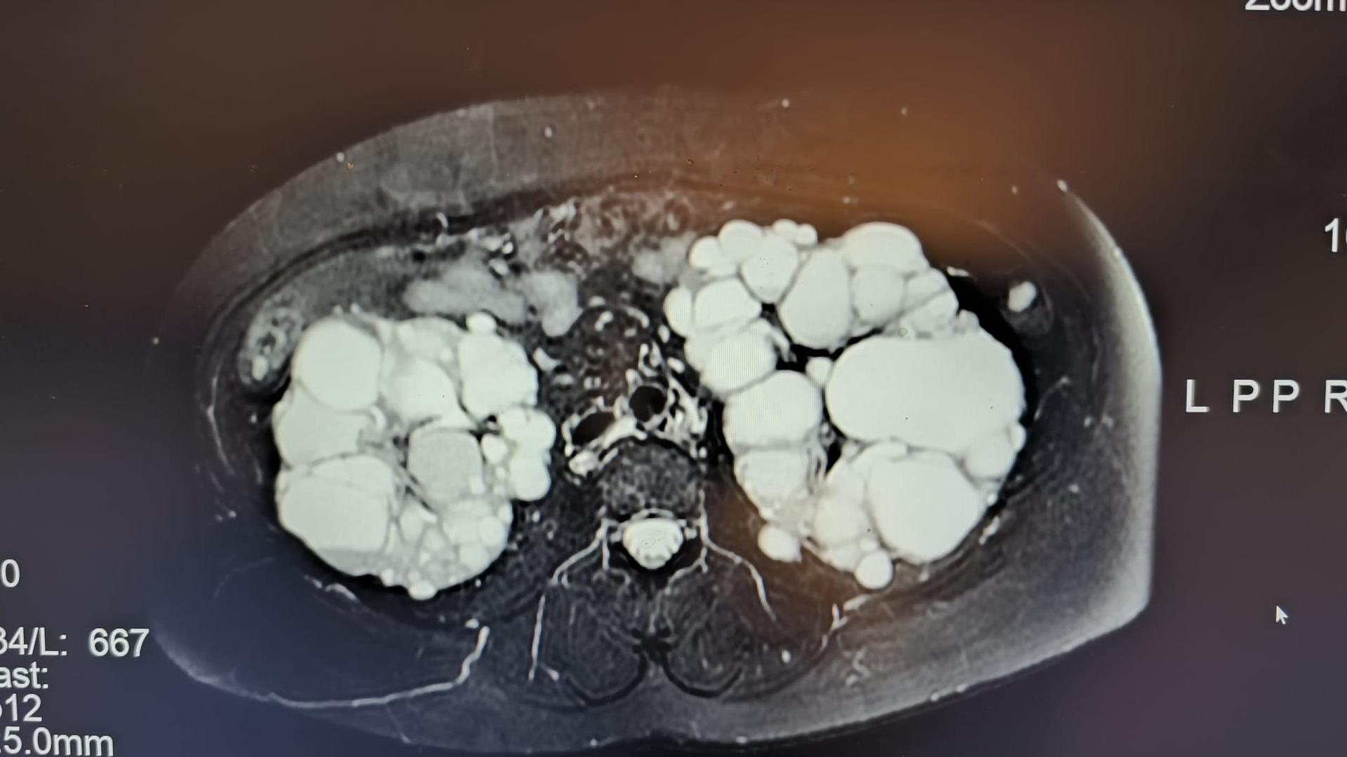 Eine Magnetresonanztomografie-Aufnahme von extrem vergrößerten Nieren mit Zysten.